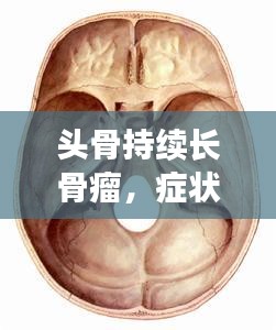 頭骨持續(xù)長骨瘤，癥狀、成因與治療方案深度解析