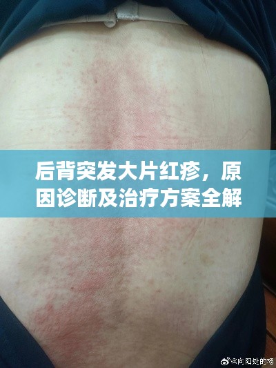 后背突發(fā)大片紅疹，原因診斷及治療方案全解析