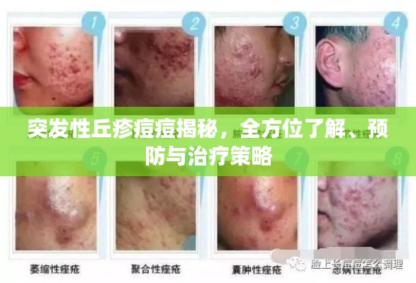 突發(fā)性丘疹痘痘揭秘，全方位了解、預(yù)防與治療策略